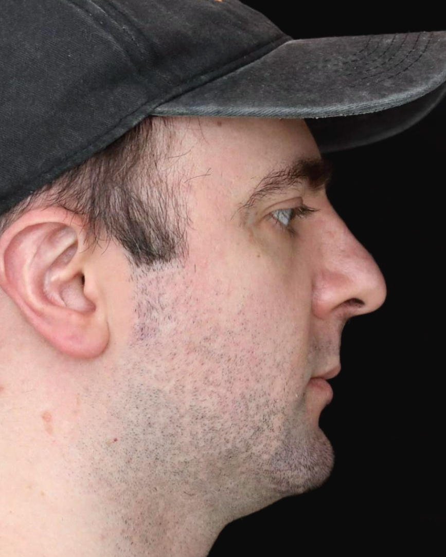 Foto de pré-operatório de rinoplastia masculina