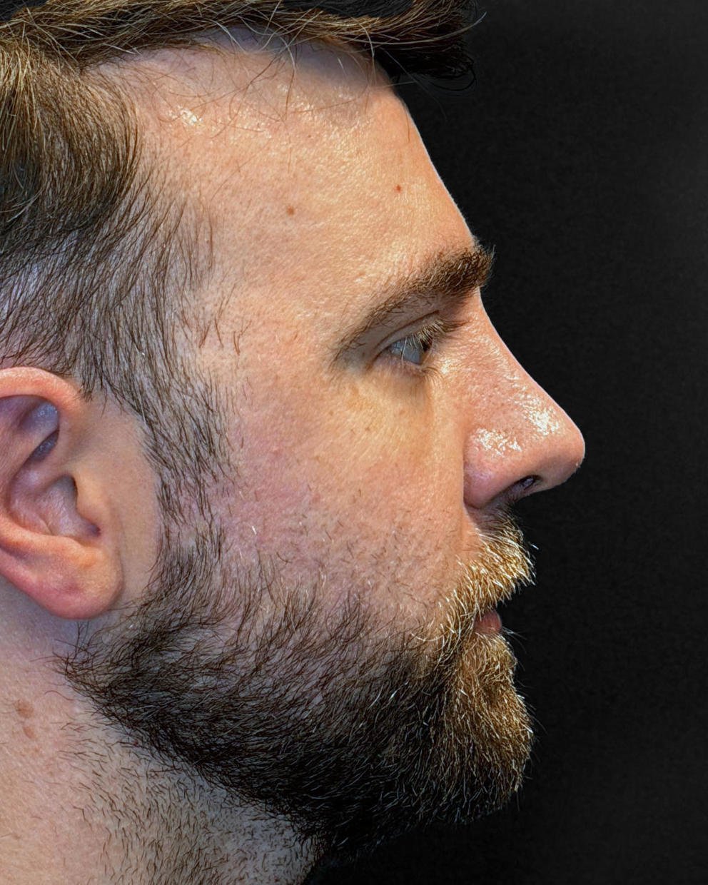 Foto de pós-operatório de rinoplastia masculina