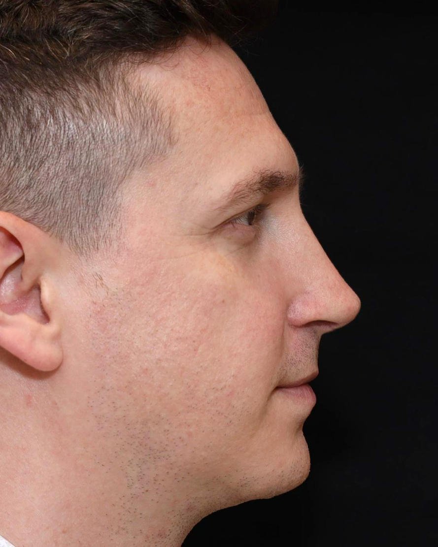 Foto de pós-operatório de rinoplastia masculina