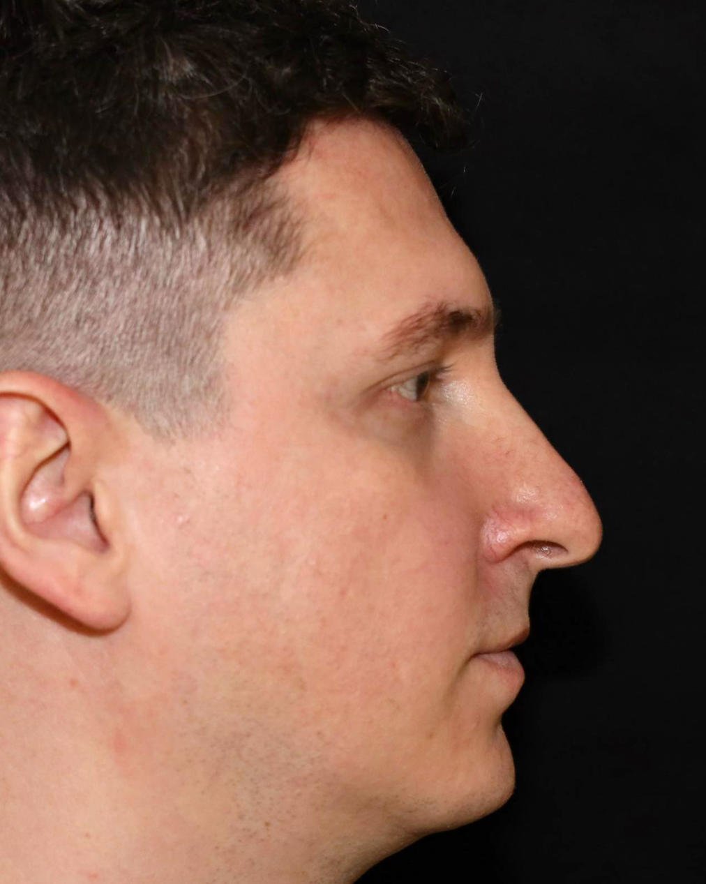 Foto de pré-operatório de rinoplastia masculina