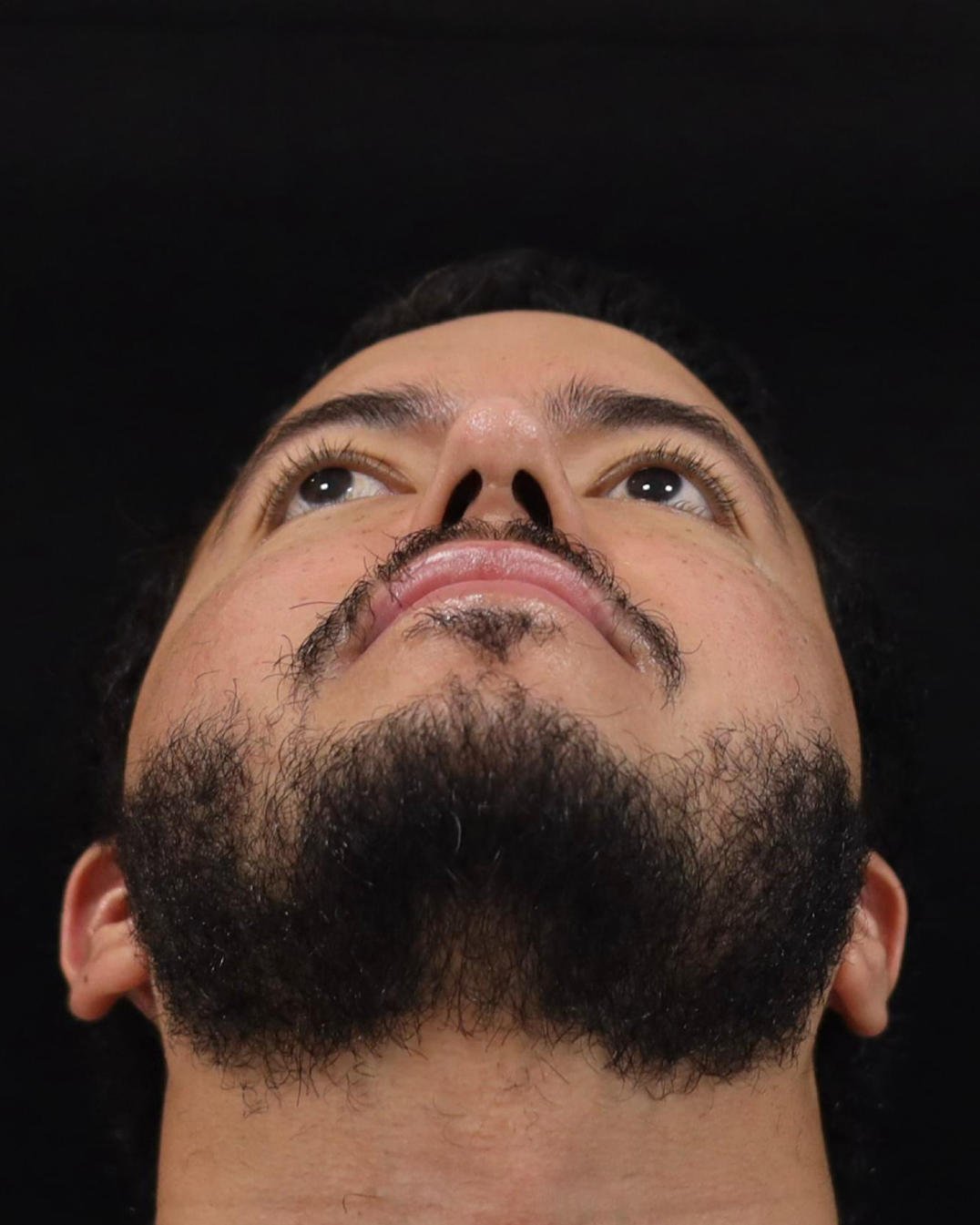 Foto de pós-operatório de rinoplastia masculina