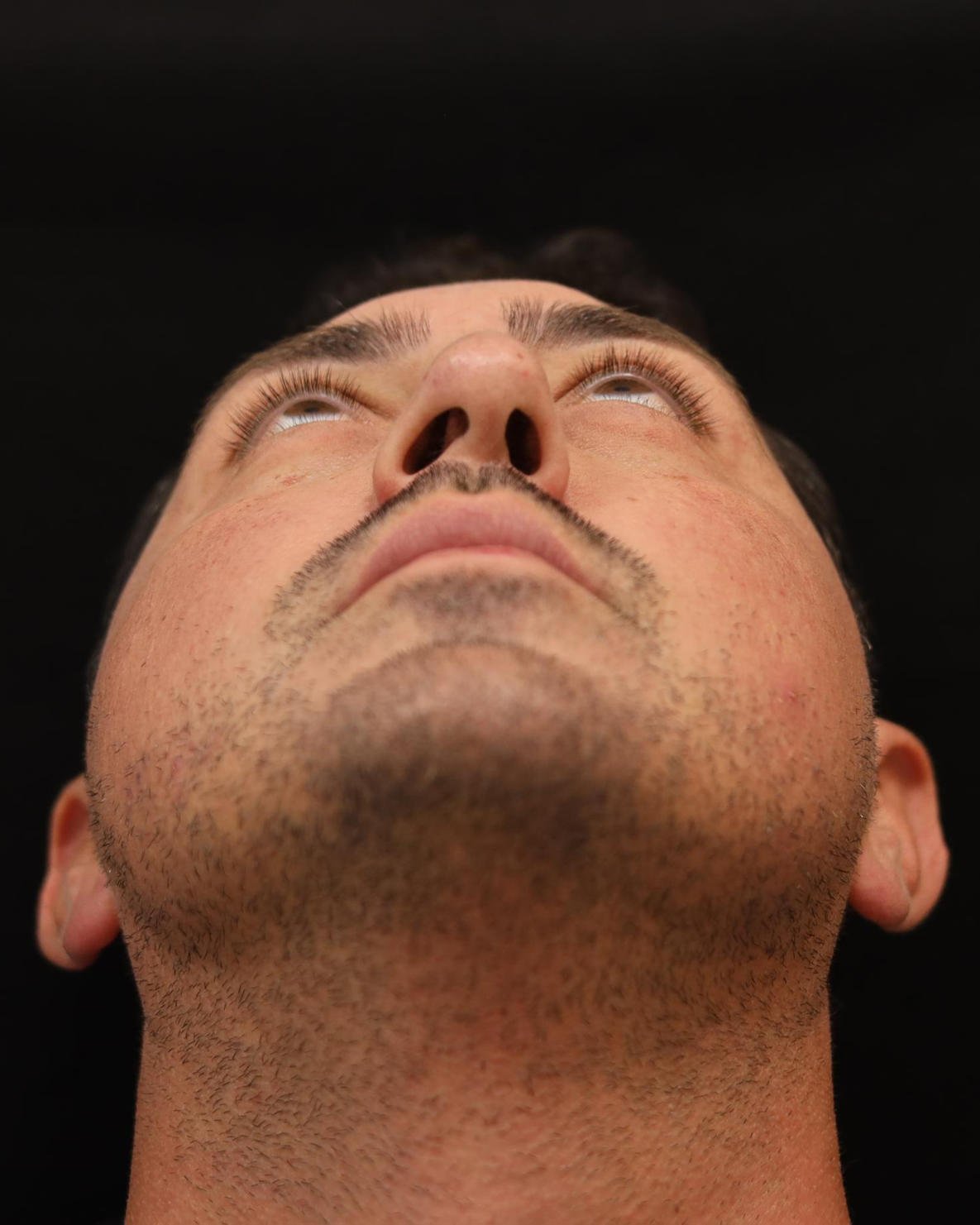 Foto de pré-operatório de rinoplastia masculina