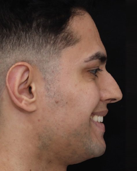 Foto de pré-operatório de rinoplastia masculina