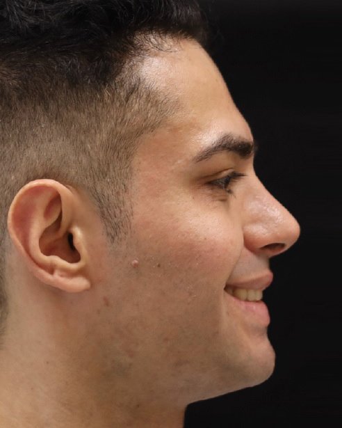 Foto de pós-operatório de rinoplastia masculina