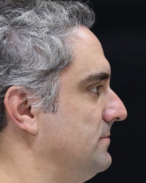 Foto de pré-operatório de rinoplastia masculina