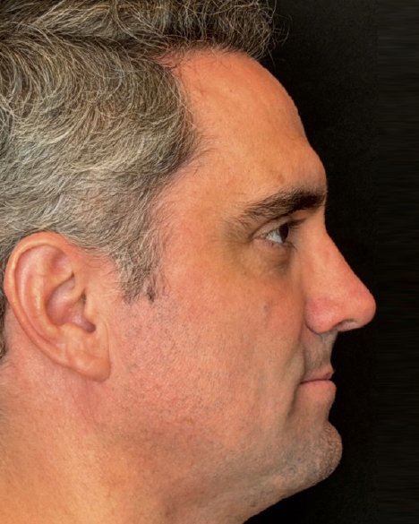 Foto de pós-operatório de rinoplastia masculina