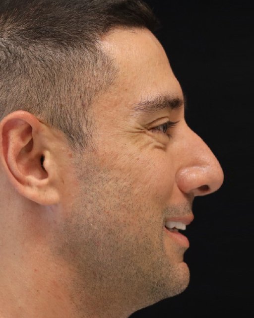 Foto de pré-operatório de rinoplastia masculina