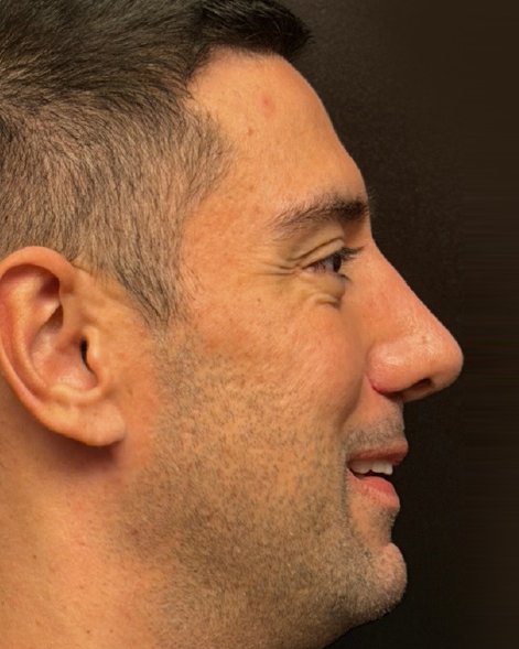Foto de pós-operatório de rinoplastia masculina
