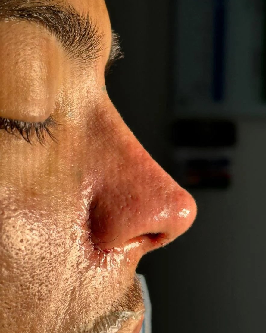 Foto de pós-operatório de rinoplastia masculina