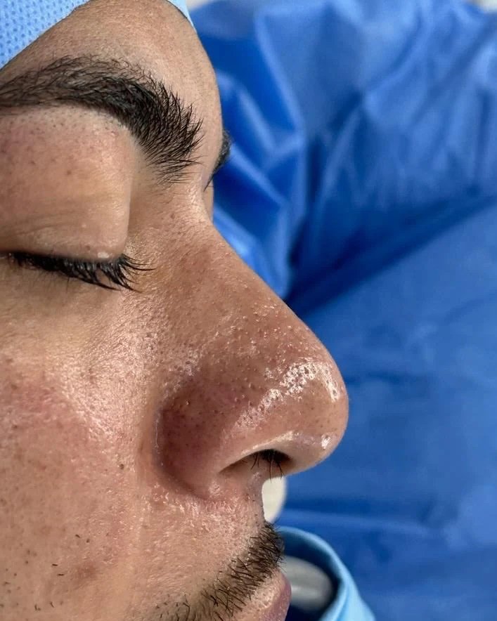 Foto de pré-operatório de rinoplastia masculina