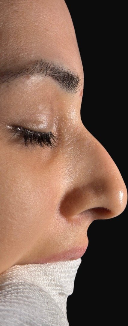 Antes da rinoplastia