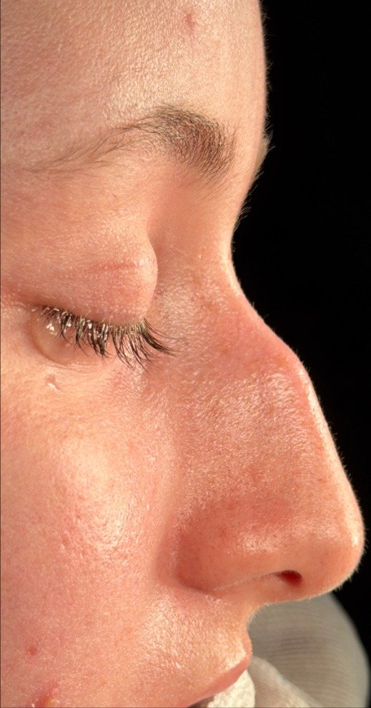 Antes da rinoplastia