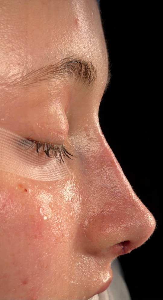 Depois da rinoplastia