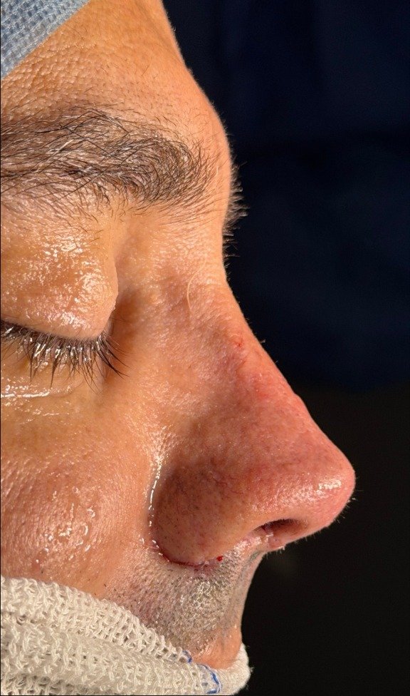 Depois da rinoplastia