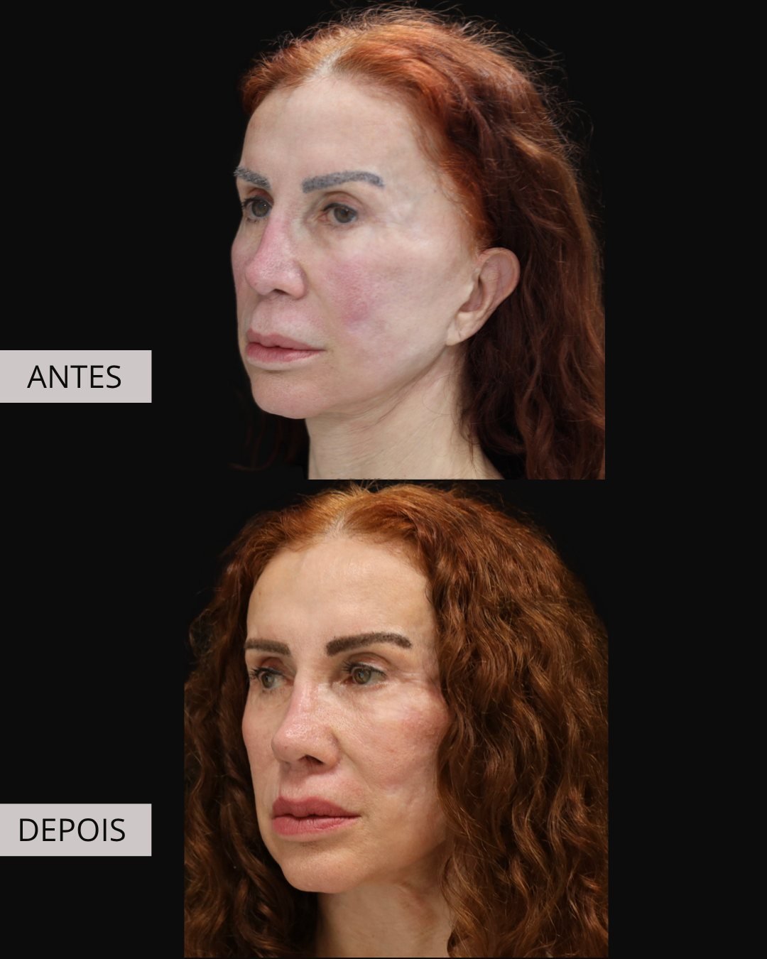 zomer-liplift-antes-depois-01