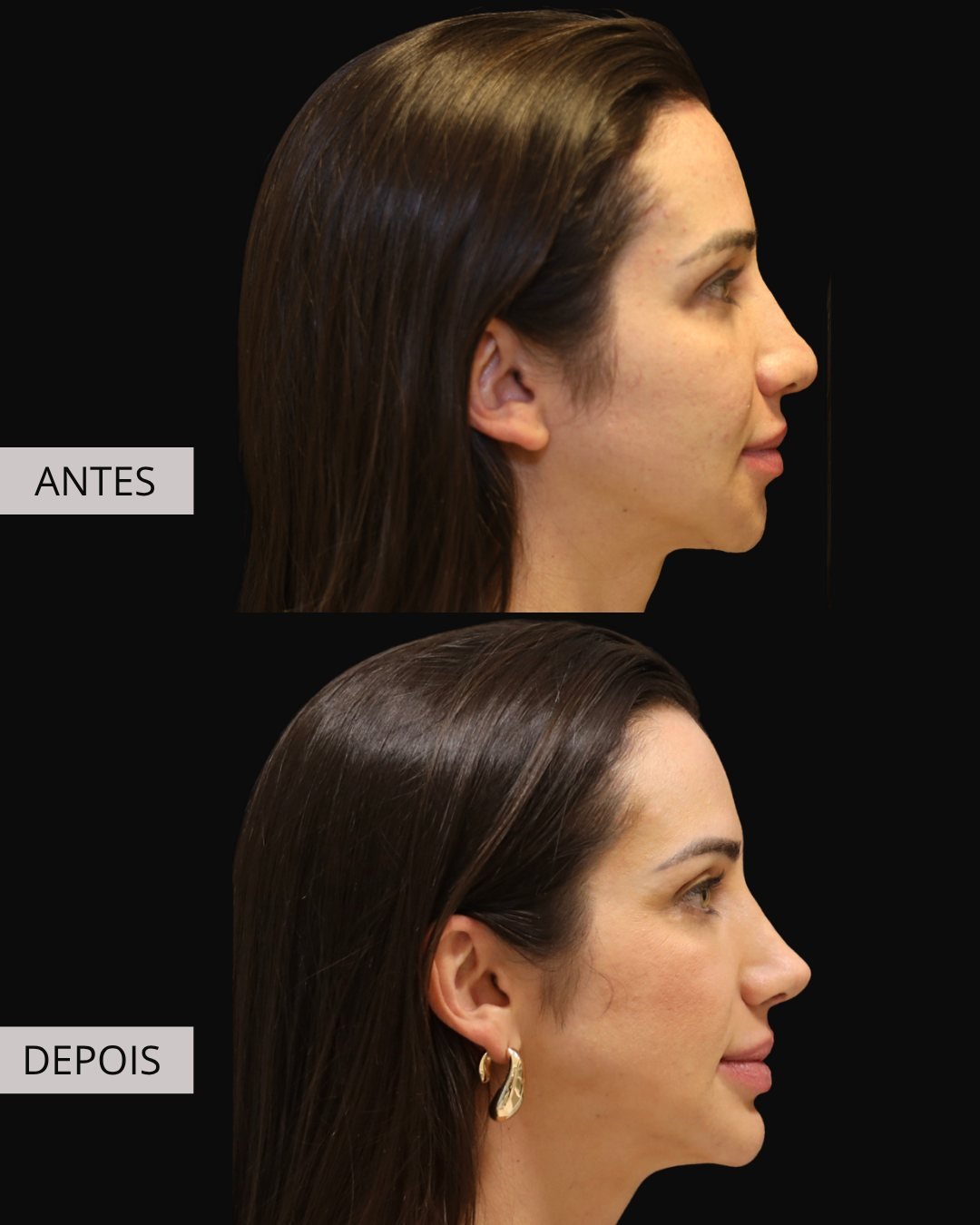 Mentoplastia antes e depois, Dr. Eduardo Zomer