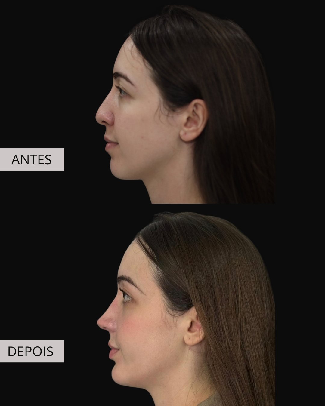 Mentoplastia antes e depois, Dr. Eduardo Zomer