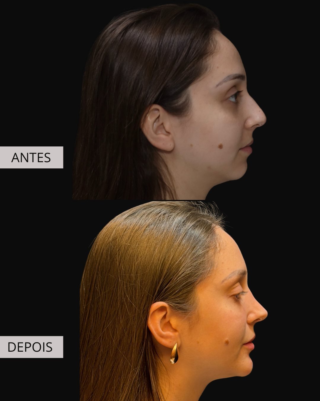 Mentoplastia antes e depois, Dr. Eduardo Zomer
