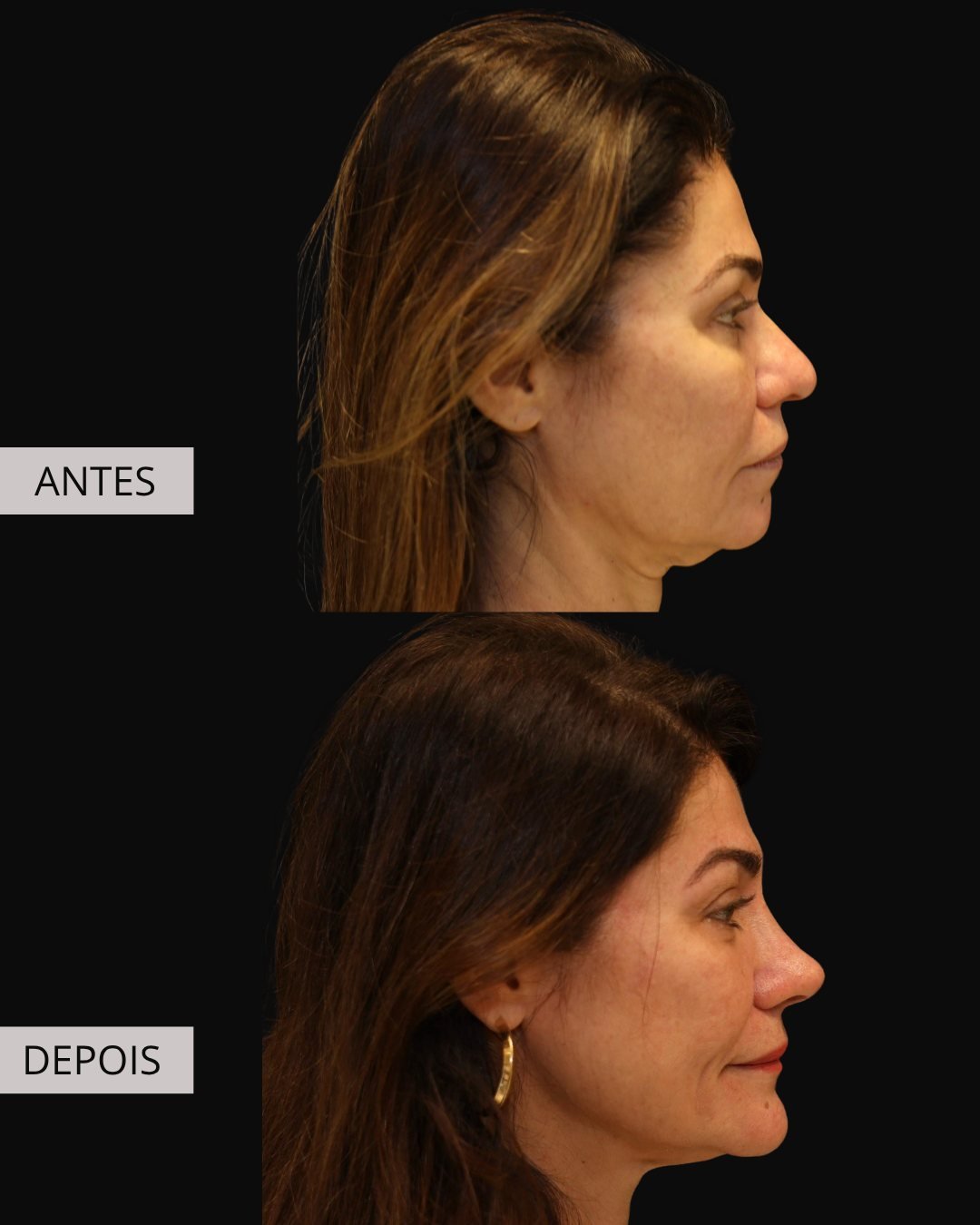 Mentoplastia antes e depois, Dr. Eduardo Zomer