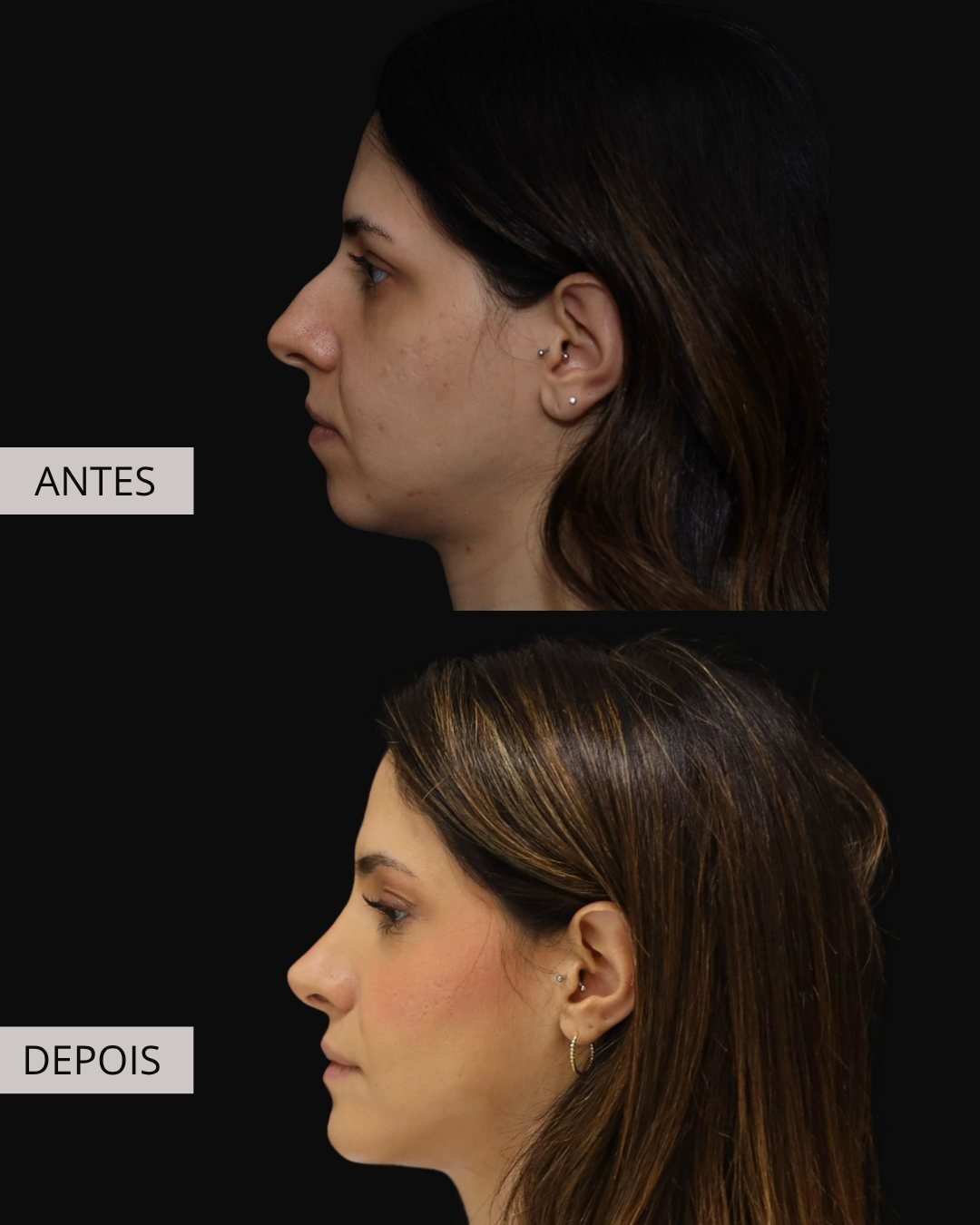 Mentoplastia antes e depois, Dr. Eduardo Zomer