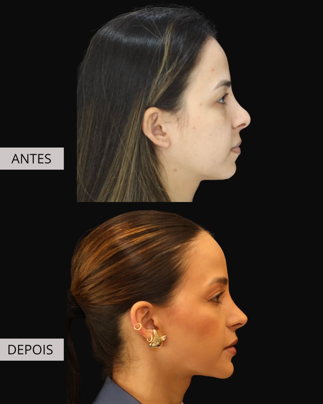 Mentoplastia antes e depois, Dr. Eduardo Zomer