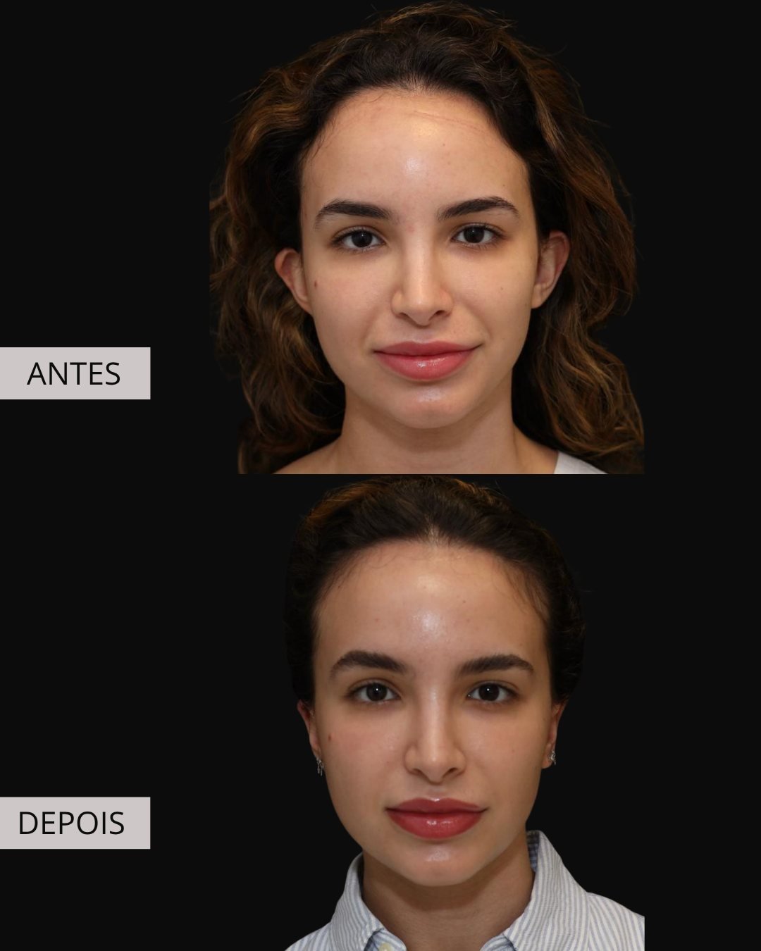Otoplastia antes e depois, Dr. Eduardo Zomer