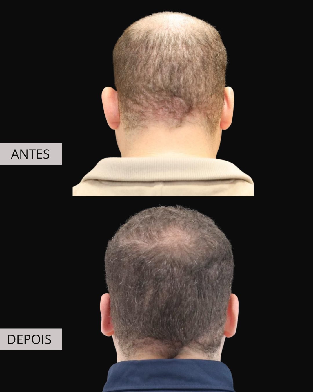 Otoplastia antes e depois, Dr. Eduardo Zomer