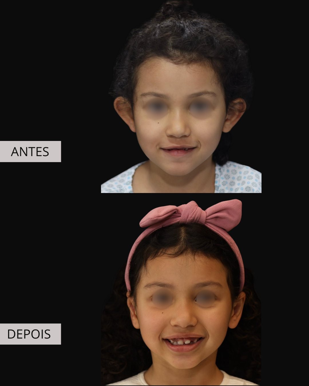 Otoplastia antes e depois, Dr. Eduardo Zomer