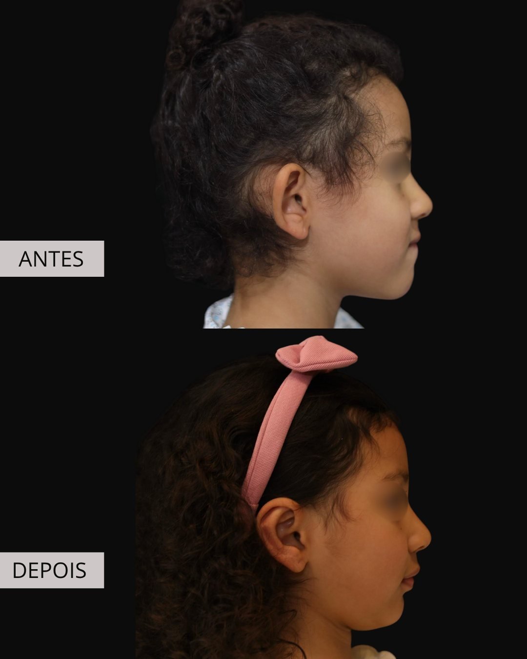 Otoplastia antes e depois, Dr. Eduardo Zomer
