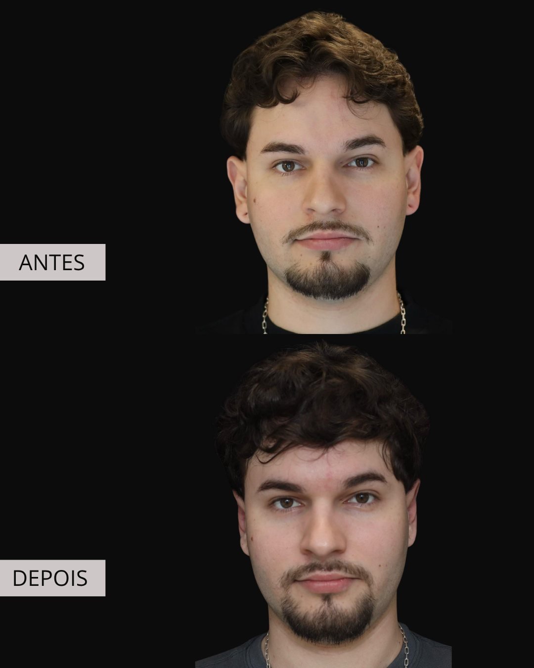 Otoplastia antes e depois, Dr. Eduardo Zomer