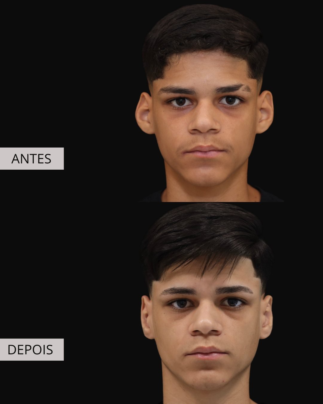 Otoplastia antes e depois, Dr. Eduardo Zomer