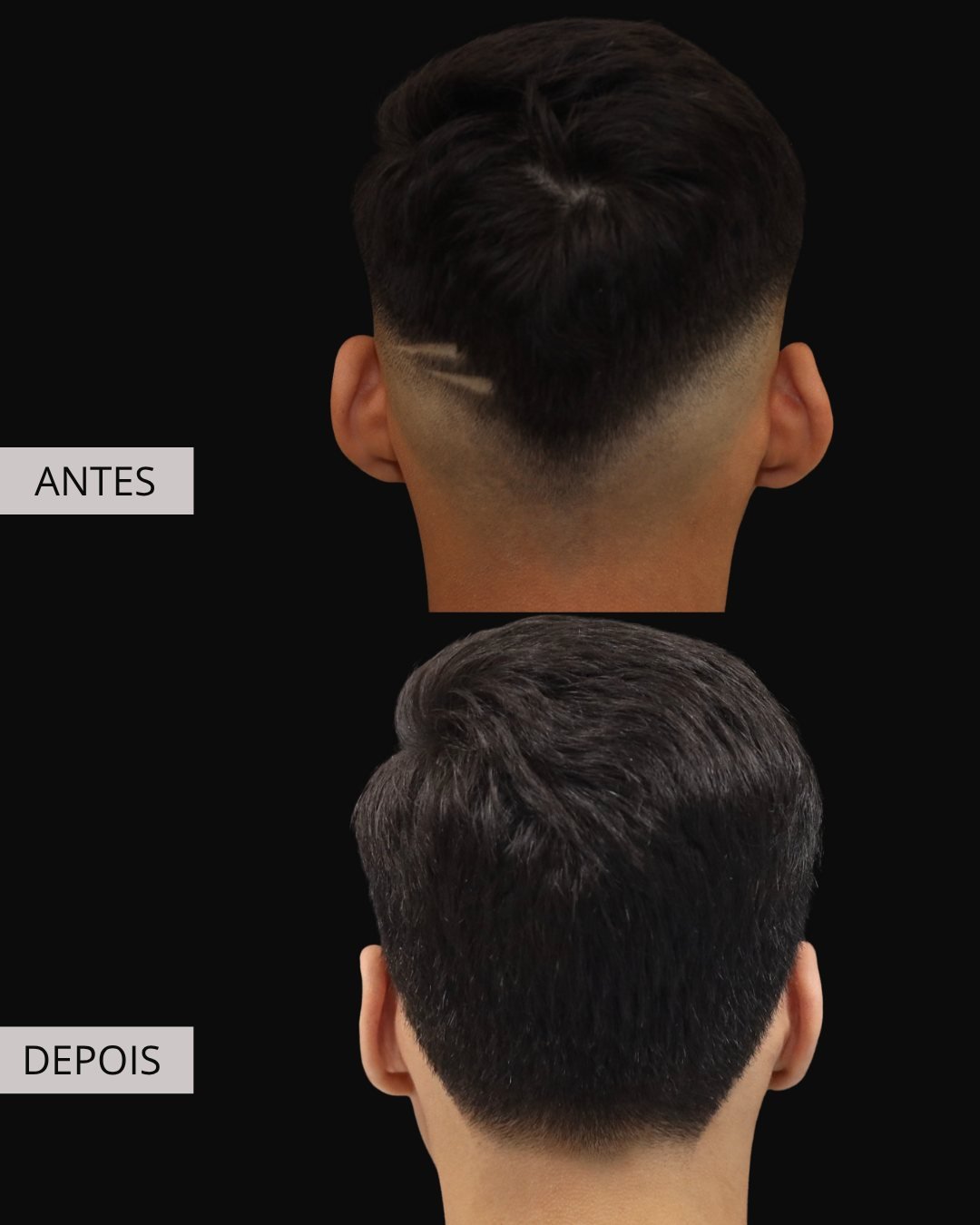 Otoplastia antes e depois, Dr. Eduardo Zomer