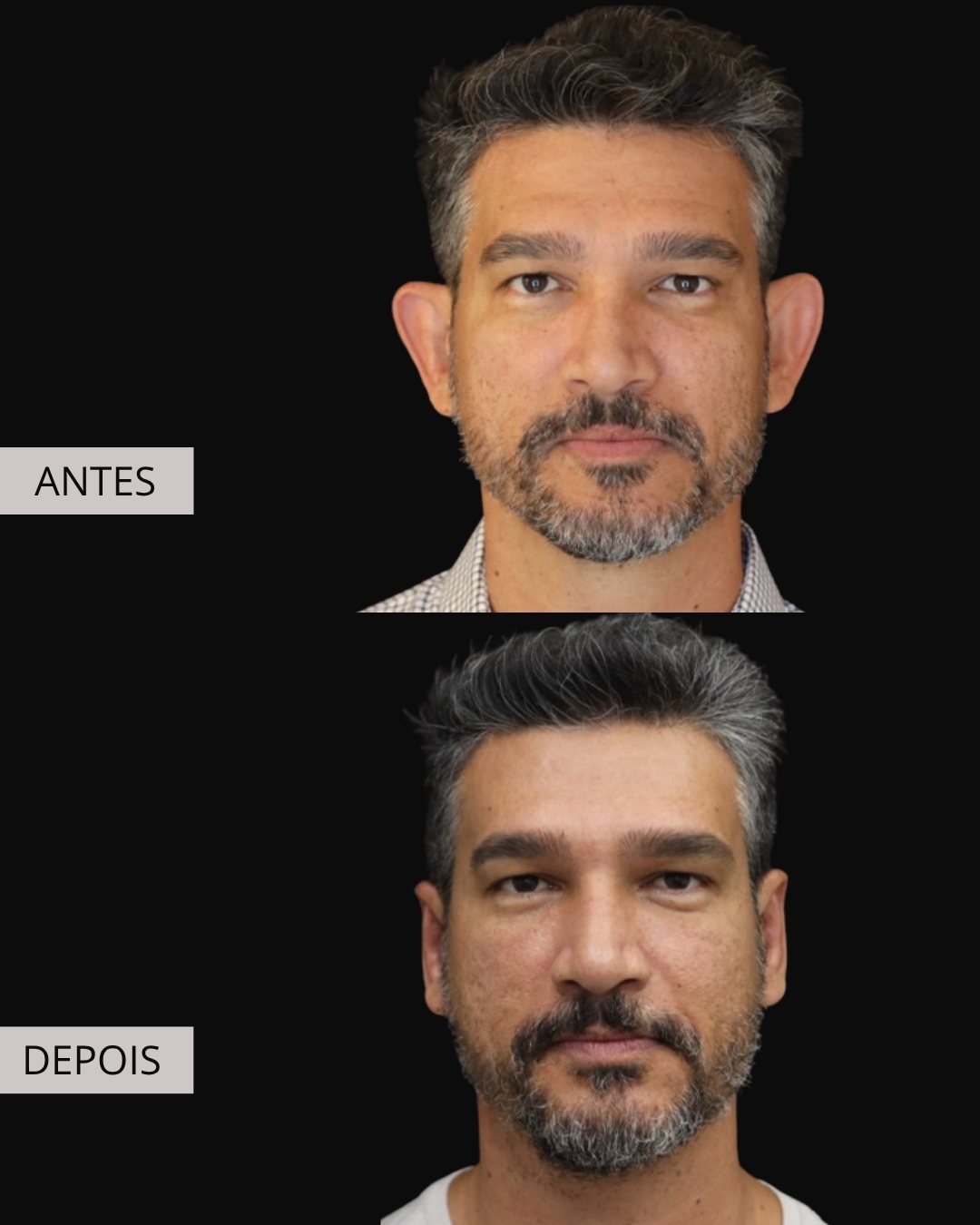 Otoplastia antes e depois, Dr. Eduardo Zomer