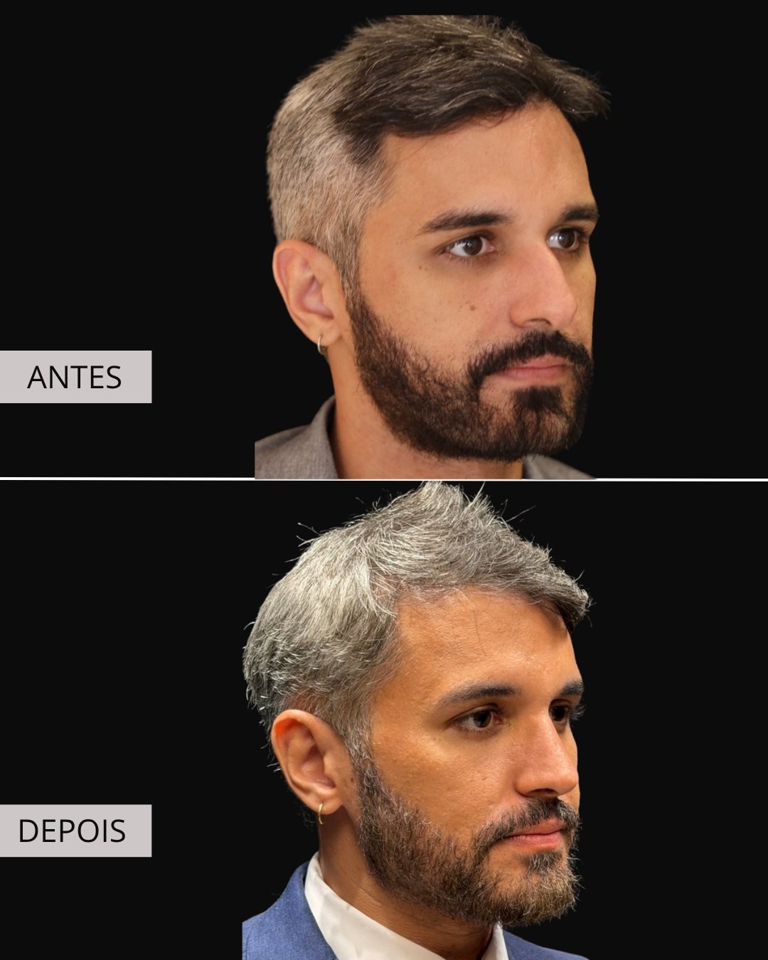 Rinoplastia antes e depois, Dr. Eduardo Zomer