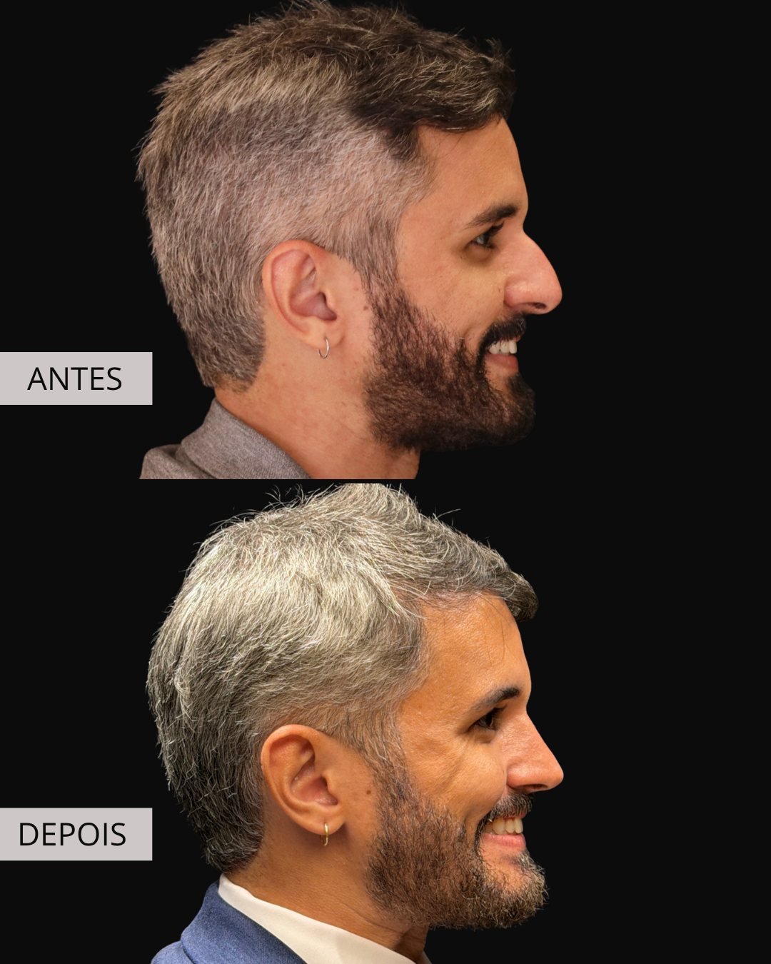 Rinoplastia antes e depois, Dr. Eduardo Zomer