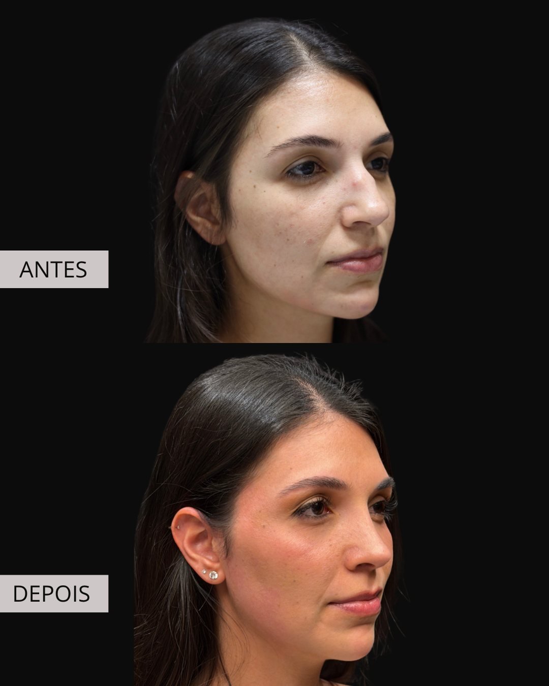 Rinoplastia antes e depois, Dr. Eduardo Zomer