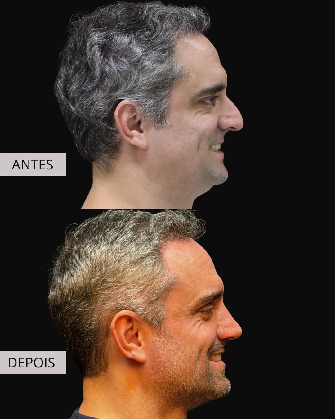 Rinoplastia antes e depois, Dr. Eduardo Zomer