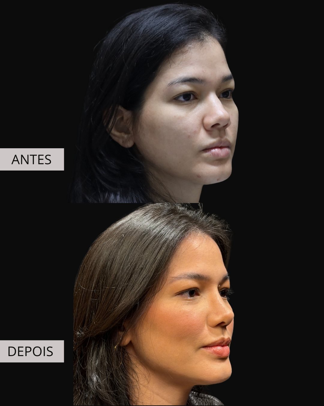 Rinoplastia antes e depois, Dr. Eduardo Zomer