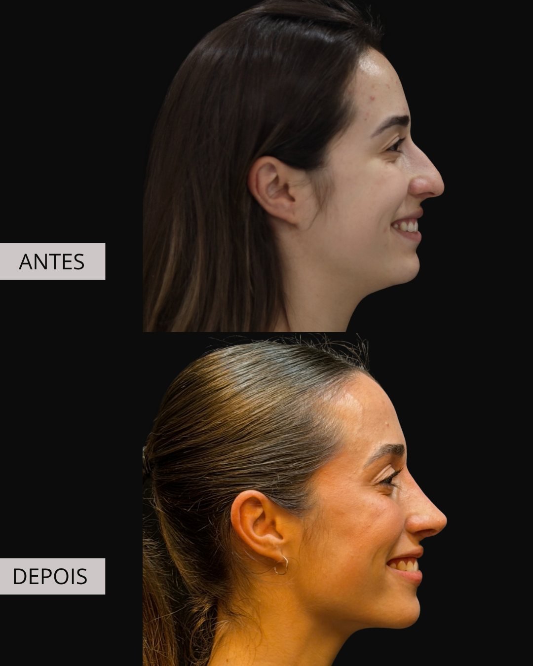 Rinoplastia antes e depois, Dr. Eduardo Zomer