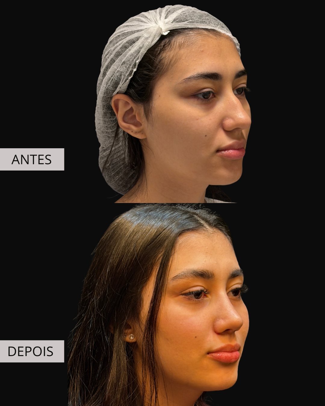 Rinoplastia antes e depois, Dr. Eduardo Zomer