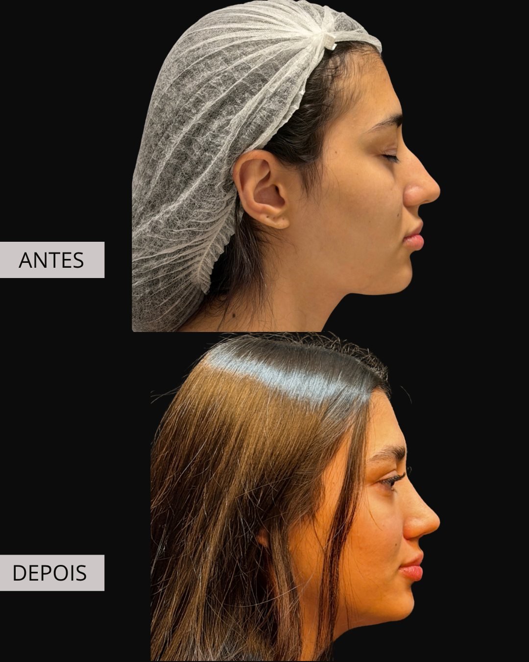 Rinoplastia antes e depois, Dr. Eduardo Zomer