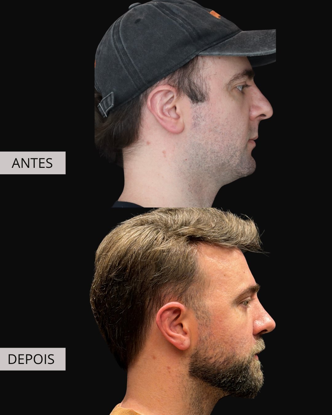 Rinoplastia antes e depois, Dr. Eduardo Zomer