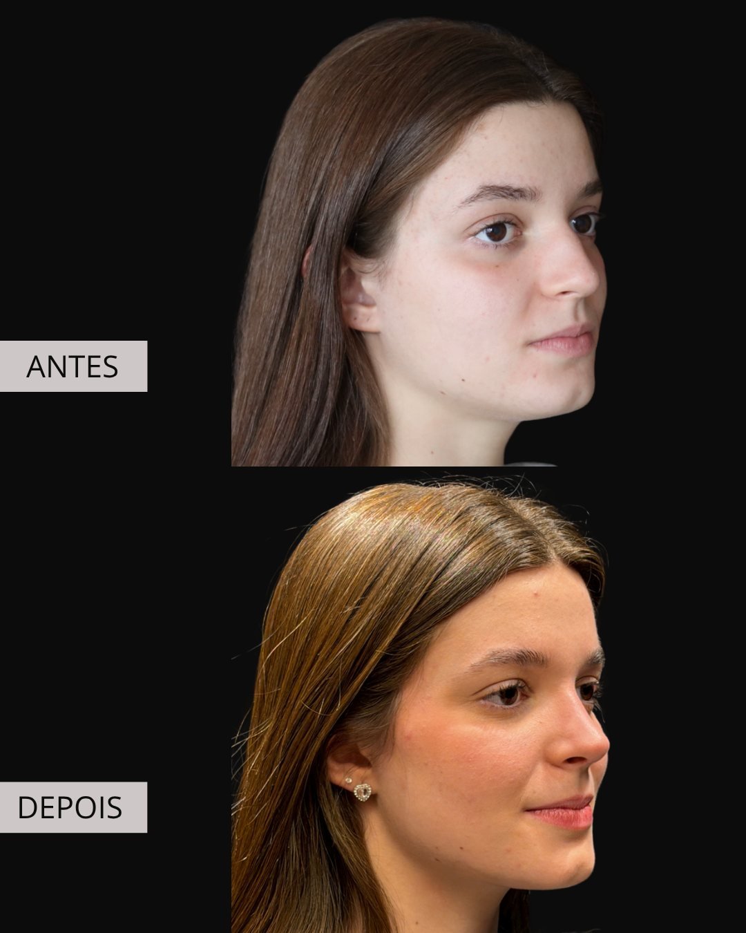Rinoplastia antes e depois, Dr. Eduardo Zomer