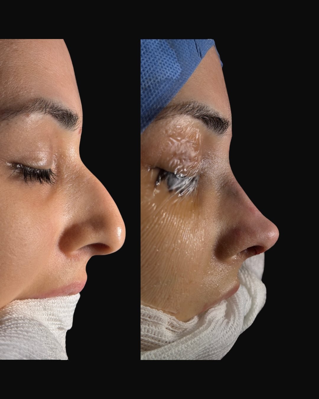 zomer-rinoplastia-sobrefoto-01