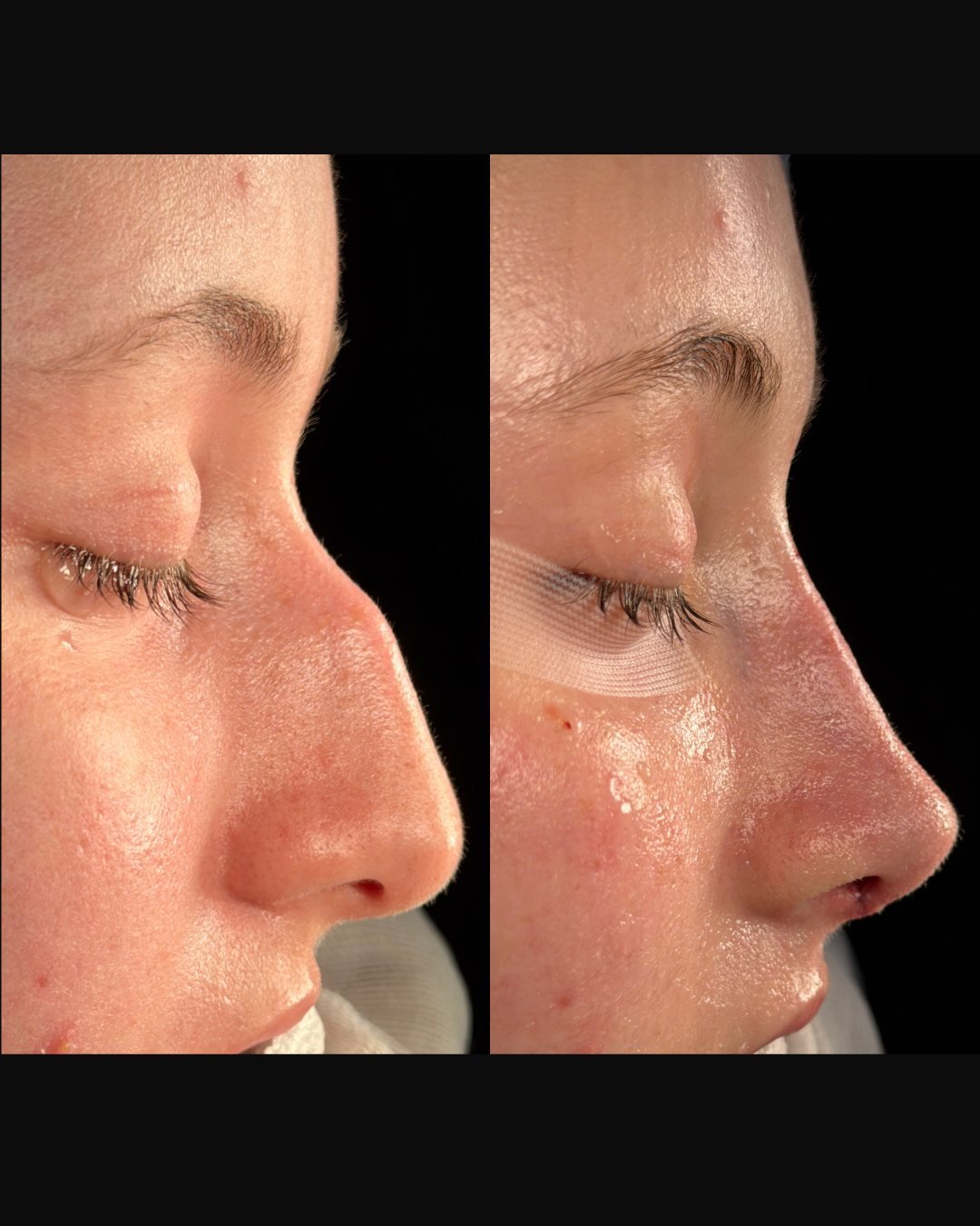 zomer-rinoplastia-sobrefoto-02