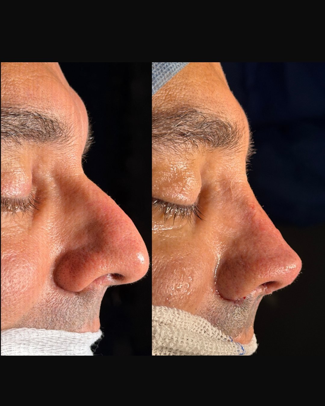 zomer-rinoplastia-sobrefoto-03